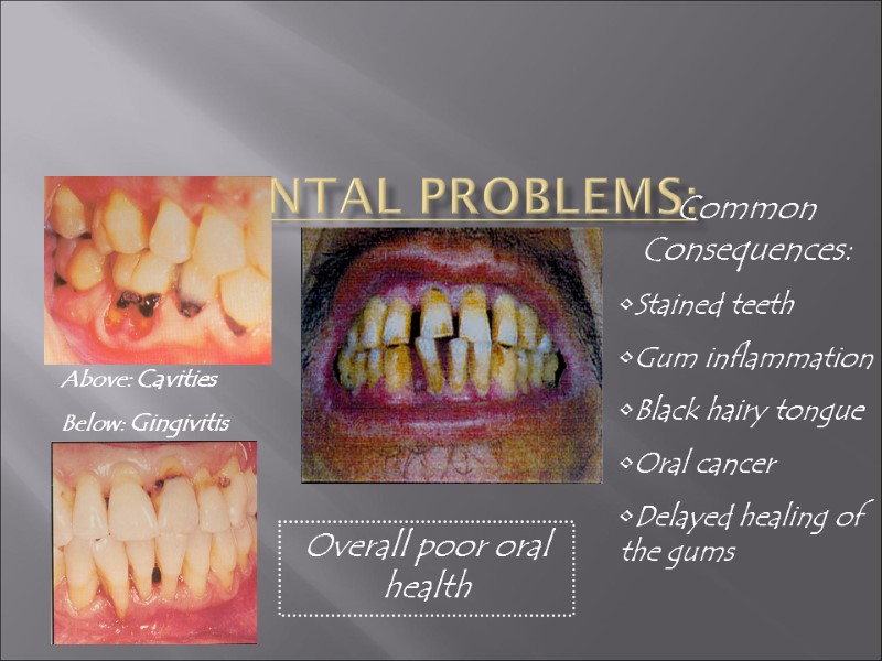 Dental Problems:  Above: Cavities Below: Gingivitis Overall poor oral health Common Consequences: Stained